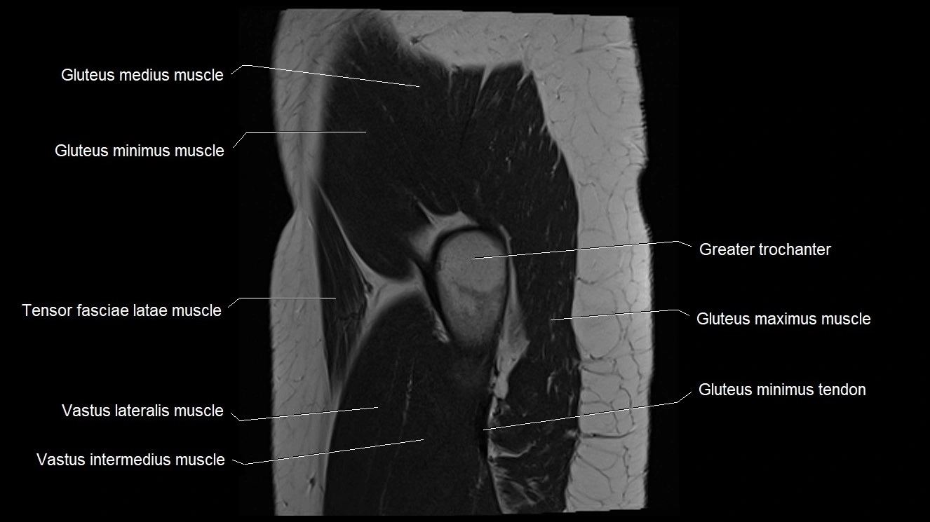 Hip sagittal cross sectional anatomy image 7.webp